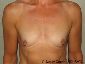 Breast Augmentation Before and After 105 | Sanjay Grover MD FACS