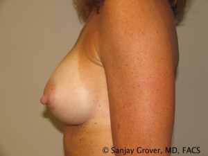 Breast Augmentation Before and After 150 | Sanjay Grover MD FACS