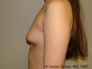 Breast Augmentation Before and After 155 | Sanjay Grover MD FACS