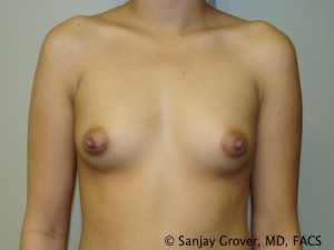 Breast Augmentation Before and After 27 | Sanjay Grover MD FACS