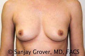 Breast Augmentation Before and After 30 | Sanjay Grover MD FACS