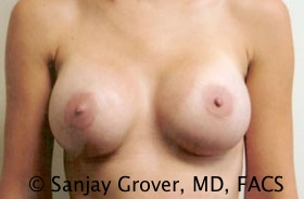 Breast Augmentation Before and After 171 | Sanjay Grover MD FACS