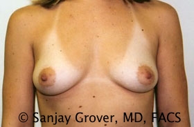 Breast Augmentation Before and After 261 | Sanjay Grover MD FACS