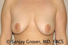 Breast Augmentation Before and After 123 | Sanjay Grover MD FACS