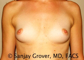 Breast Augmentation Before and After 185 | Sanjay Grover MD FACS