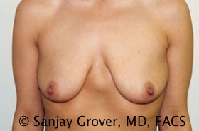 Breast Augmentation Before and After 36 | Sanjay Grover MD FACS