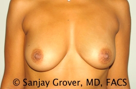 Breast Augmentation Before and After 293 | Sanjay Grover MD FACS