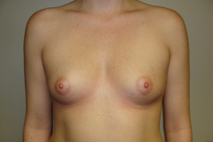 Breast Augmentation Before and After 288 | Sanjay Grover MD FACS