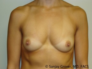 Breast Augmentation Before and After 162 | Sanjay Grover MD FACS