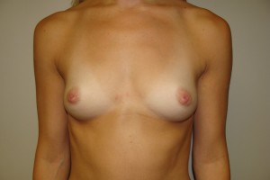 Breast Augmentation Before and After 58 | Sanjay Grover MD FACS