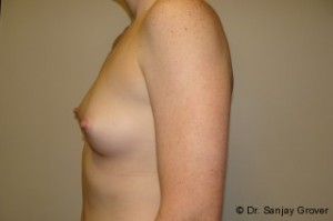 Breast Augmentation Before and After 218 | Sanjay Grover MD FACS