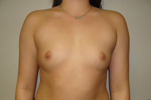Breast Augmentation Before and After 115 | Sanjay Grover MD FACS