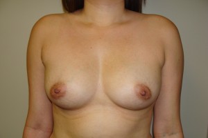 Breast Augmentation Before and After 56 | Sanjay Grover MD FACS