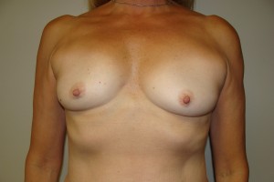 Breast Augmentation Before and After 239 | Sanjay Grover MD FACS