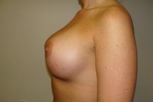 Breast Augmentation Before and After 253 | Sanjay Grover MD FACS