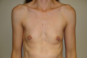 Breast Augmentation Before and After 48 | Sanjay Grover MD FACS