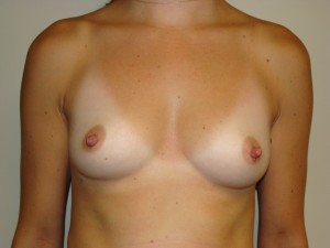 Breast Augmentation Before and After 285 | Sanjay Grover MD FACS