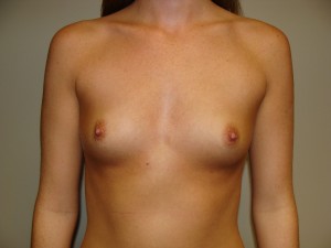 Breast Augmentation Before and After 57 | Sanjay Grover MD FACS