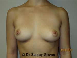 Breast Augmentation Before and After 85 | Sanjay Grover MD FACS