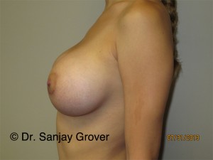 Breast Augmentation Before and After 274 | Sanjay Grover MD FACS