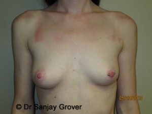 Breast Augmentation Before and After 152 | Sanjay Grover MD FACS