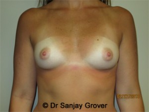 Breast Augmentation Before and After 78 | Sanjay Grover MD FACS