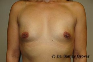 Breast Augmentation Before and After 307 | Sanjay Grover MD FACS