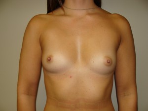 Breast Augmentation Before and After 295 | Sanjay Grover MD FACS