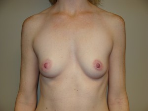 Breast Augmentation Before and After 195 | Sanjay Grover MD FACS