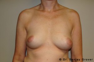 Breast Augmentation Before and After 135 | Sanjay Grover MD FACS