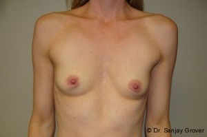 Breast Augmentation Before and After 217 | Sanjay Grover MD FACS