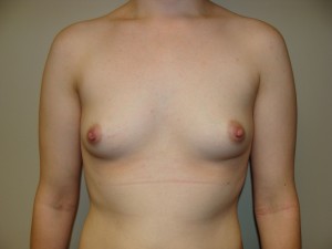 Breast Augmentation Before and After 106 | Sanjay Grover MD FACS
