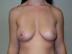 Breast Augmentation Before and After 08 | Sanjay Grover MD FACS