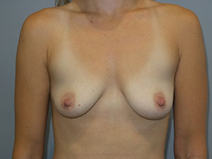 Breast Augmentation Before and After 278 | Sanjay Grover MD FACS