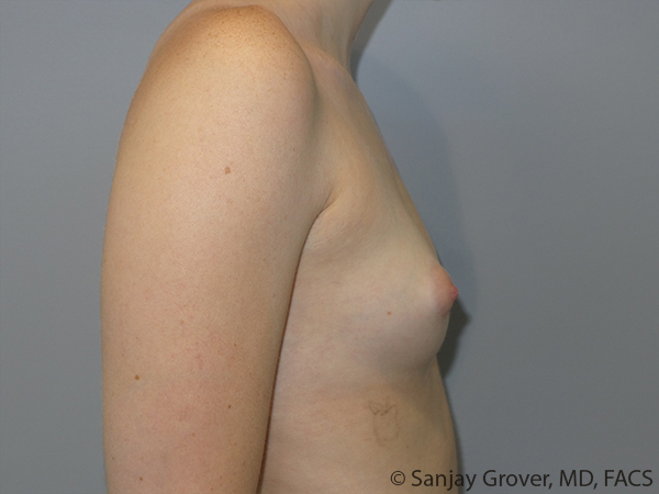 Breast Augmentation Before and After 309 | Sanjay Grover MD FACS