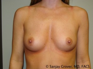 Breast Augmentation Before and After 58 | Sanjay Grover MD FACS
