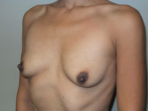 Breast Augmentation Before and After 312 | Sanjay Grover MD FACS