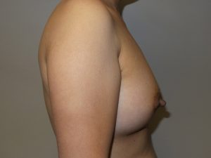 Breast Augmentation Before and After 34 | Sanjay Grover MD FACS