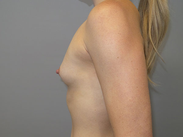 Breast Augmentation Before and After 44 | Sanjay Grover MD FACS