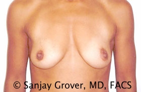 Breast Augmentation Before and After 130 | Sanjay Grover MD FACS