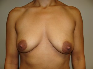 Breast Augmentation Before and After 77 | Sanjay Grover MD FACS
