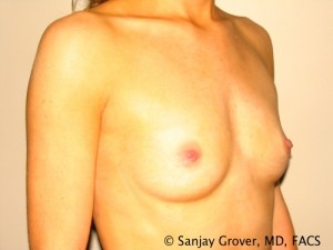 Breast Augmentation Before and After 53 | Sanjay Grover MD FACS