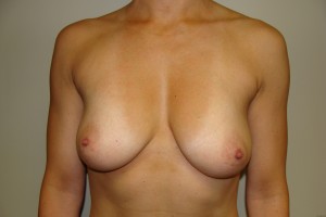 Breast Augmentation Before and After 243 | Sanjay Grover MD FACS