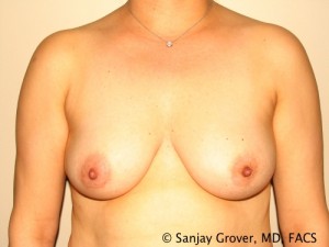 Breast Augmentation Before and After 156 | Sanjay Grover MD FACS