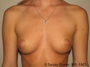 Breast Augmentation Before and After 139 | Sanjay Grover MD FACS