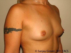 Breast Augmentation Before and After 77 | Sanjay Grover MD FACS