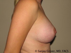 Breast Augmentation Before and After 90 | Sanjay Grover MD FACS