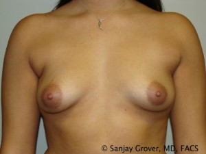 Breast Augmentation Before and After 215 | Sanjay Grover MD FACS