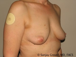 Breast Augmentation Before and After 93 | Sanjay Grover MD FACS