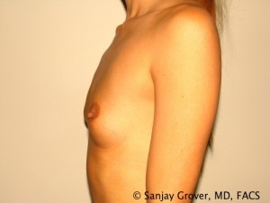 Breast Augmentation Before and After 97 | Sanjay Grover MD FACS